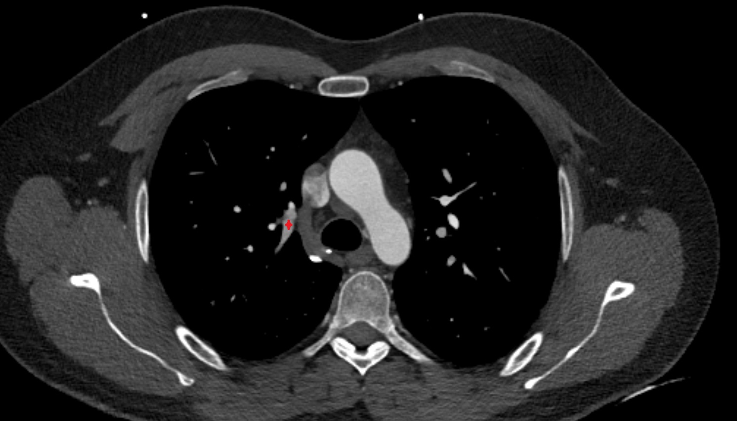 Apical segmental artery of right  lung    anatomy ct axial  image -img-00000-00000