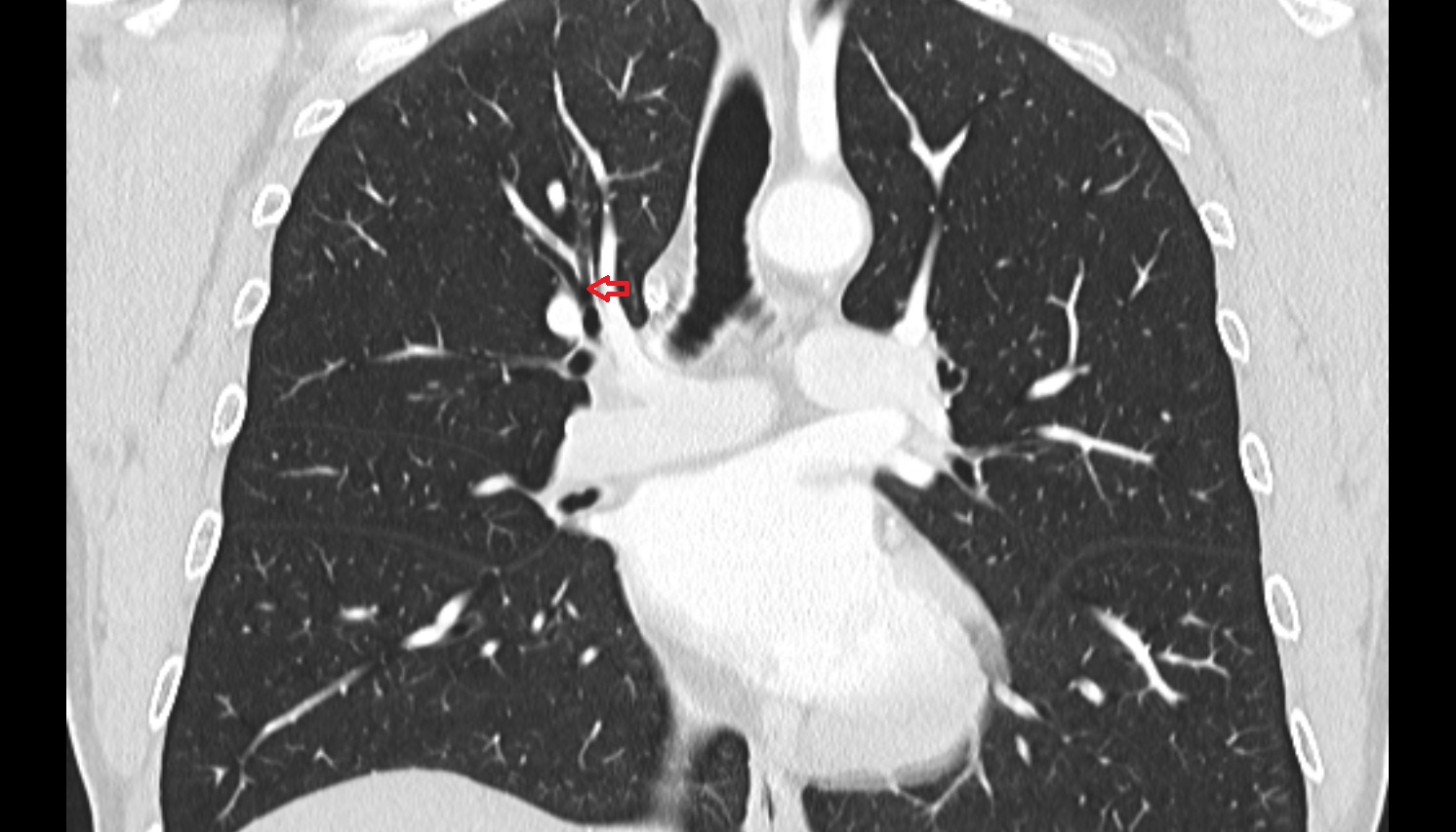 Apical segmental bronchus of right lung  anatomy CT coronal  image -img-00000-00000