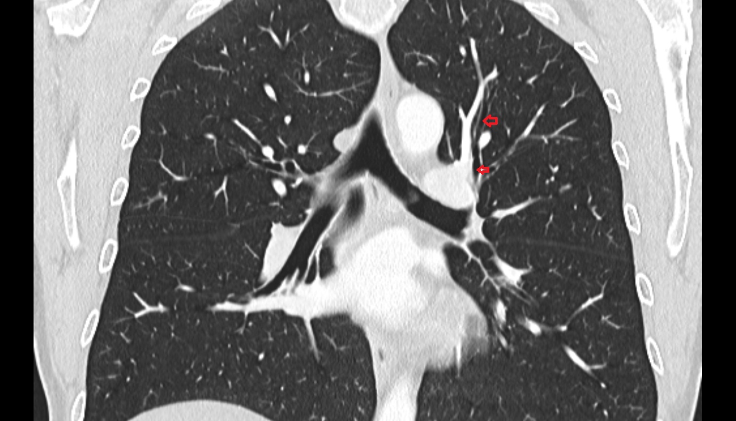 Apicoposterior segmental bronchus of left lung  anatomy CT coronal  image -img-00000-00000