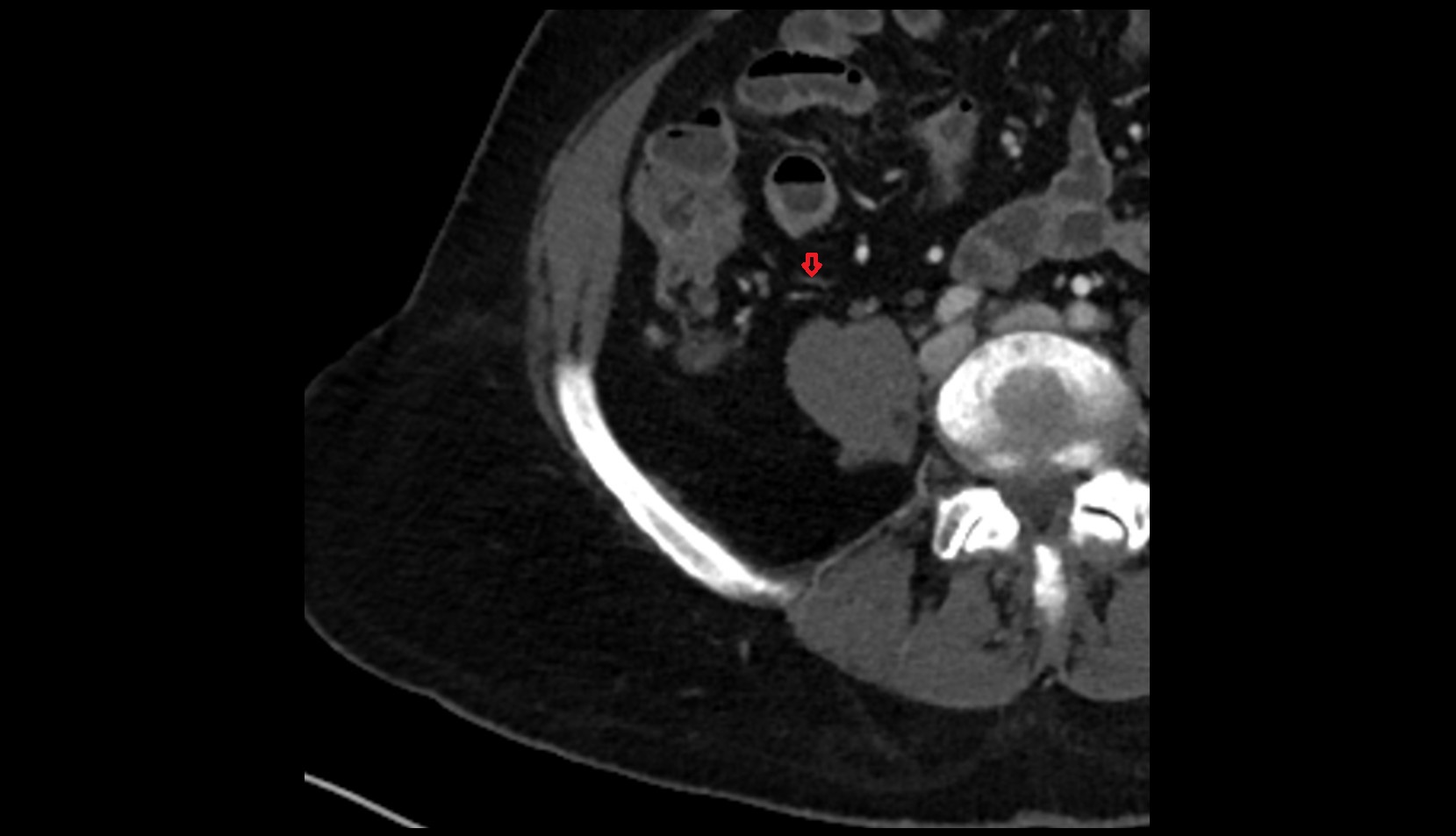 Appendicular artery CT axial anatomy image