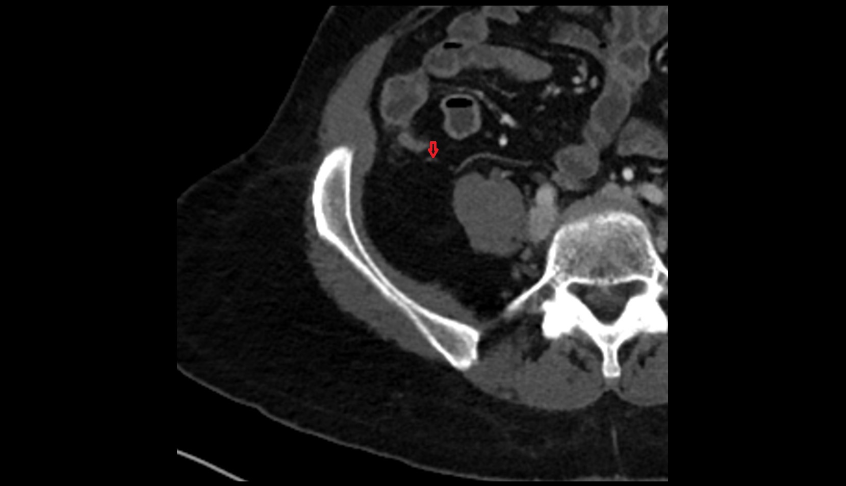 Appendicular artery CT axial anatomy image  1