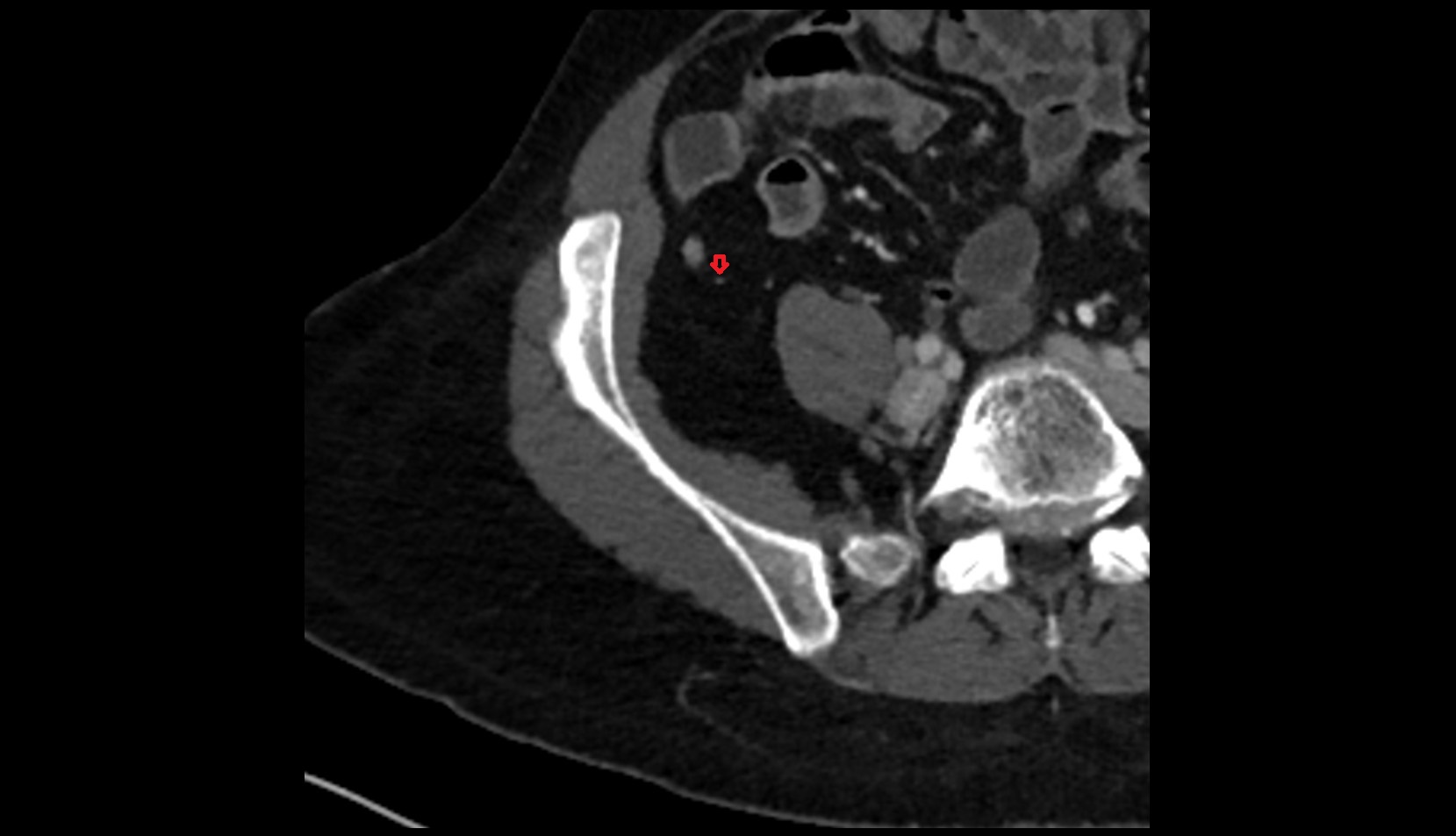 Appendicular artery CT axial anatomy image 2