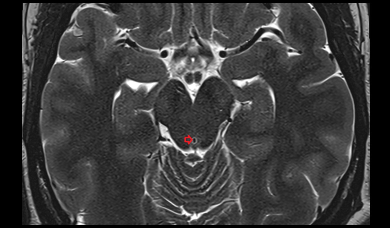 Aqueduct of midbrain; Cerebral aqueduct (Sylvius) mri 3t axial image