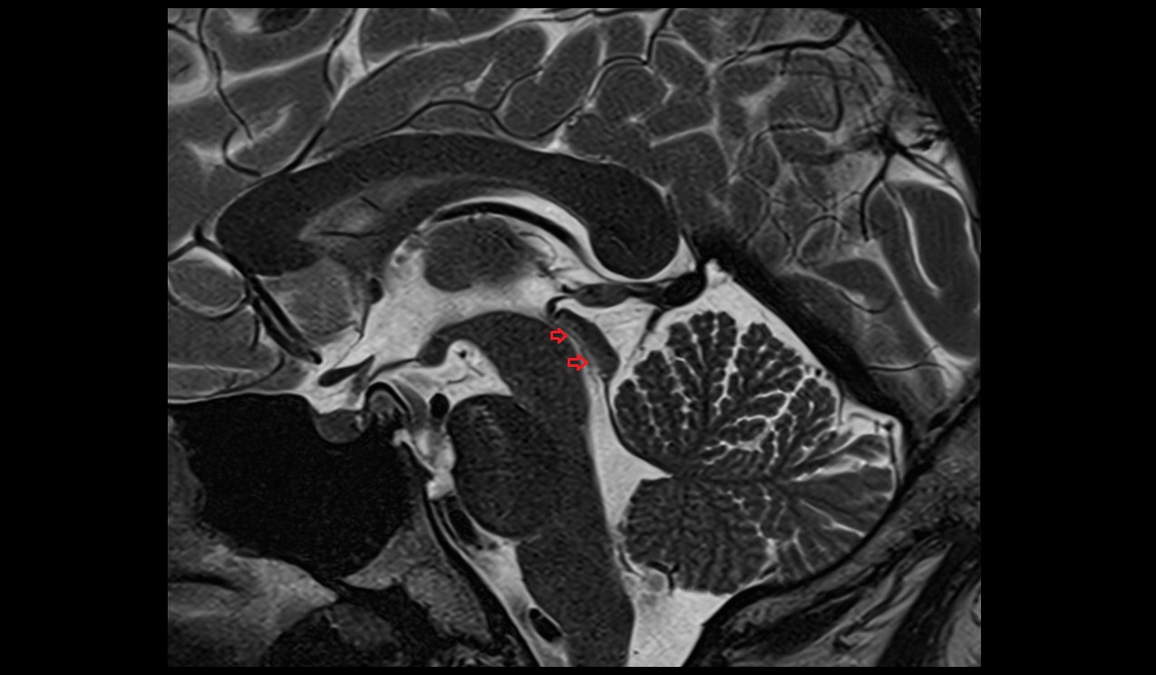 Aqueduct of midbrain; Cerebral aqueduct (Sylvius) mri 3t sagittal image