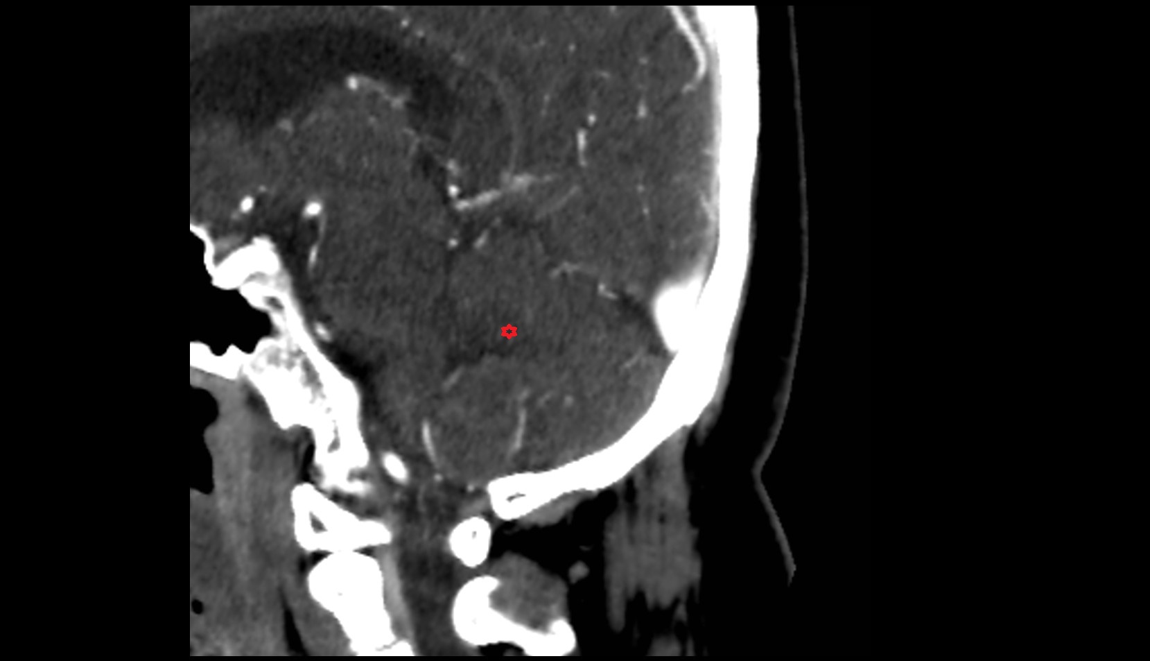 Arbor Vitae (Cerebellar White Matter)  ct image