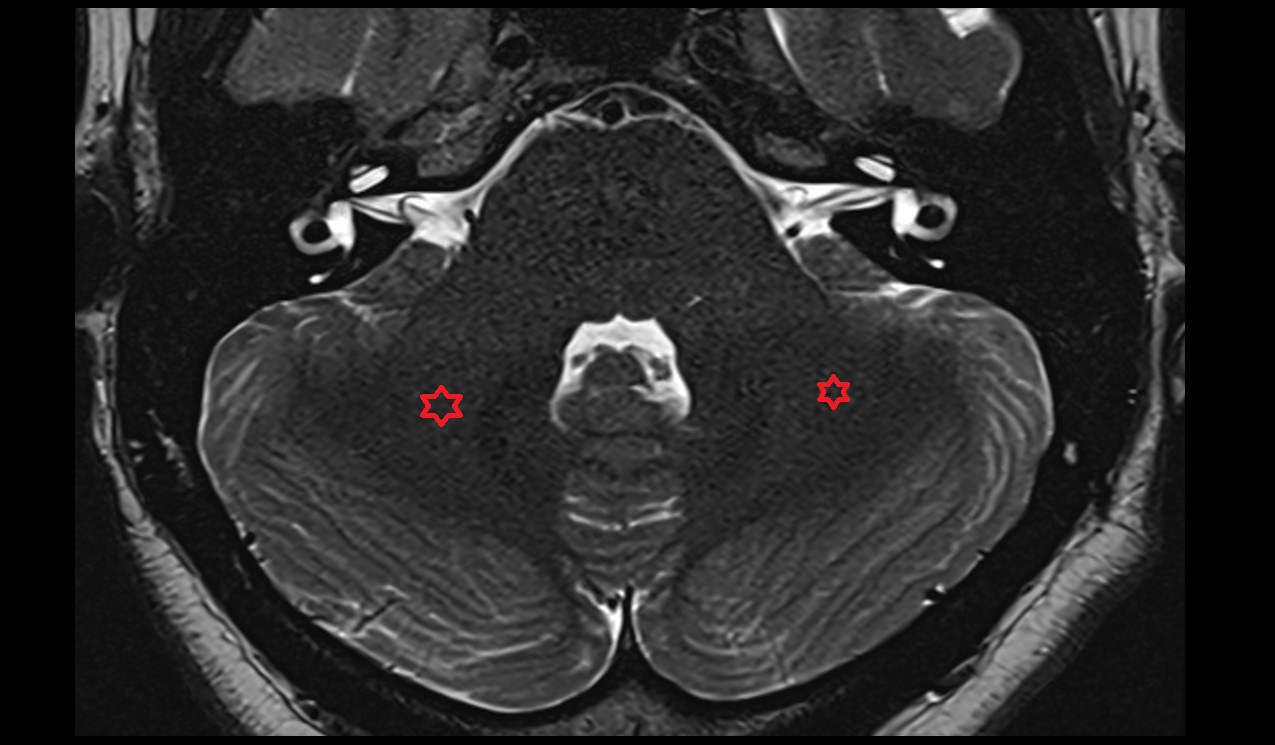 Arbor vitae (Cerebellar white matter) MRI 3T coronal  image