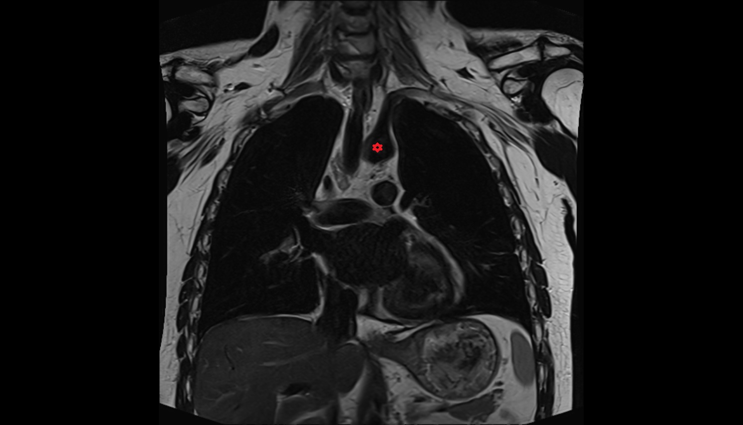Arch of aorta anatomy MRI coronal  image -img-00000-00000