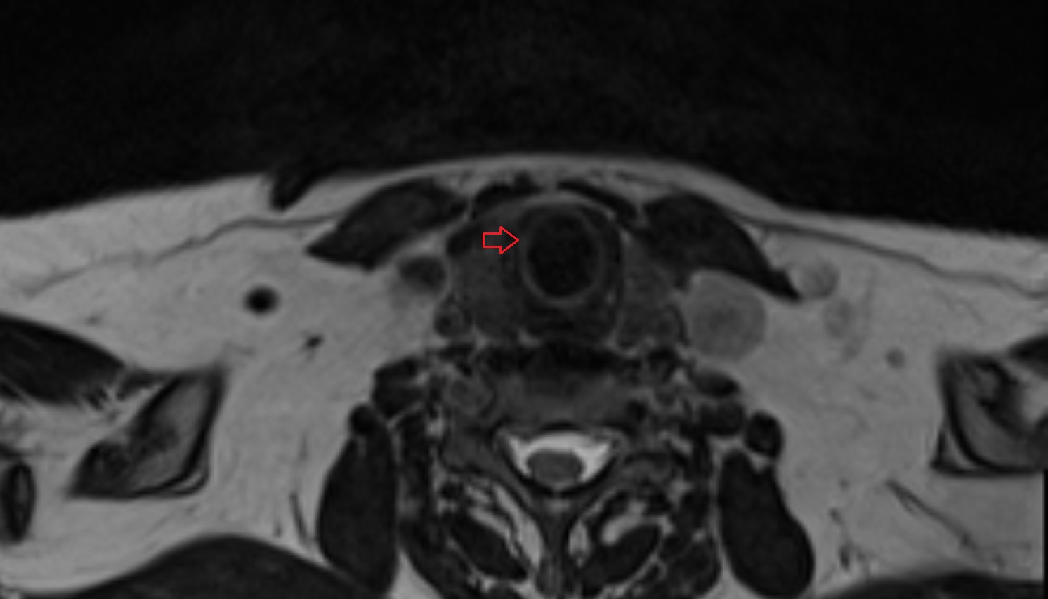 Arch of cricoid cartilage  mri axial image -img-00000-00000