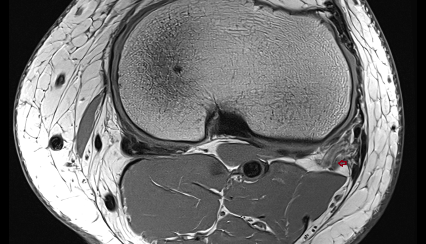 Arcuate popliteal ligament axial cross sectional anatomy 3T MRI AI enhanced  radiology  anatomy image-img-00000-00000