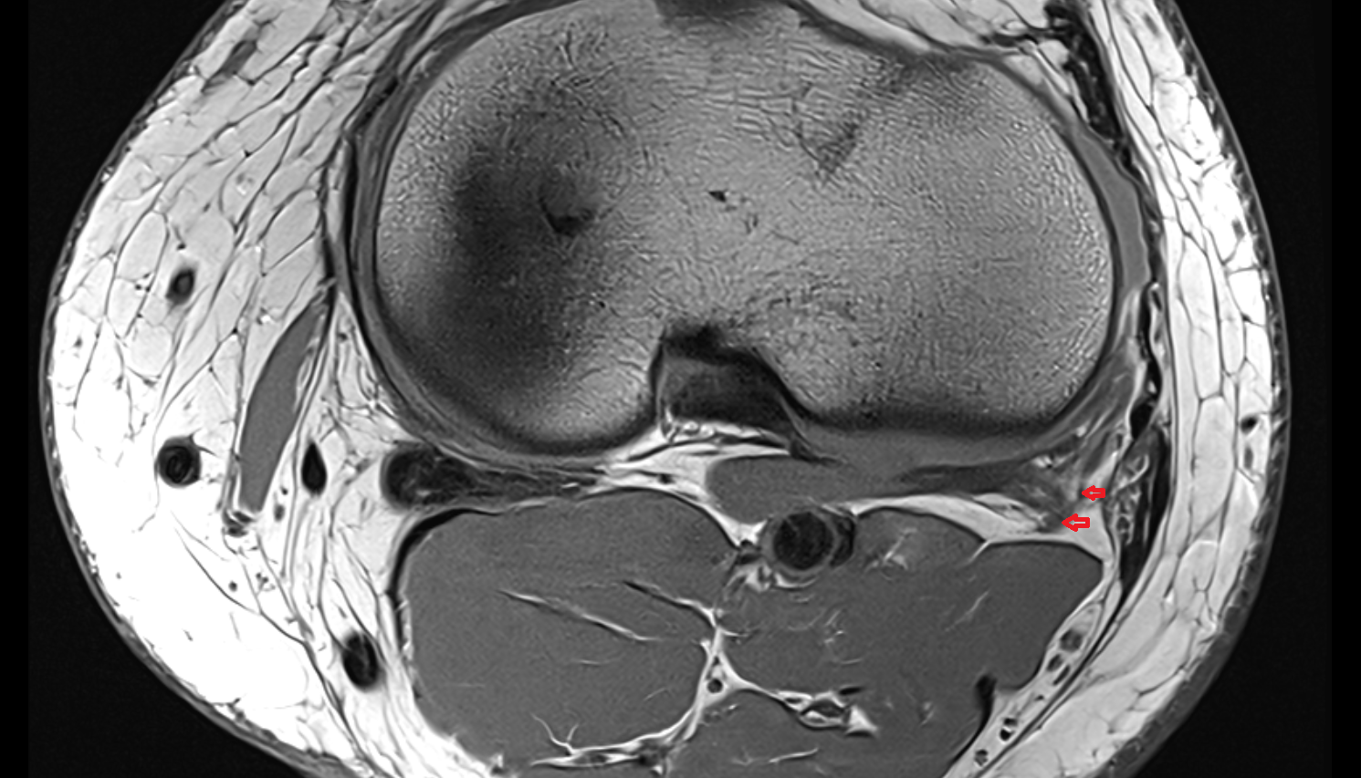 Arcuate popliteal ligament axial cross sectional anatomy 3T MRI AI enhanced  radiology  anatomy image-img-00000-00000_00001
