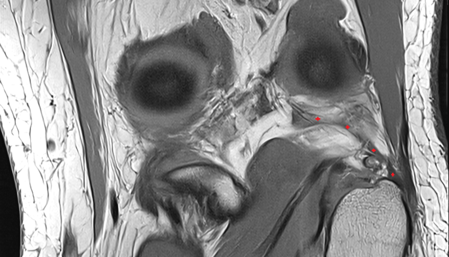 Arcuate popliteal ligament coronal cross sectional anatomy 3T MRI AI enhanced  radiology  anatomy image-img-00000-00000