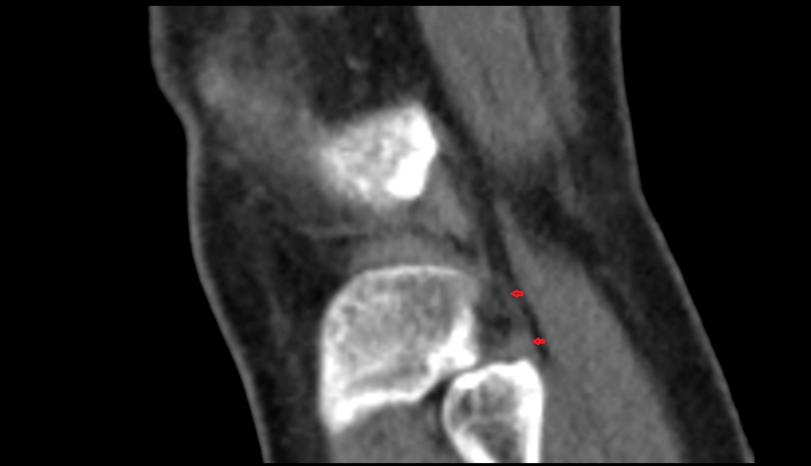 Arcuate popliteal ligament  ct sagittal image