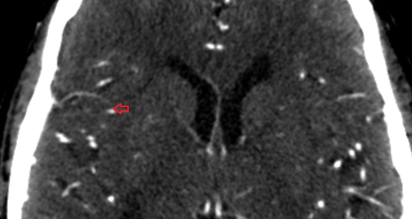 Artery of central sulcus anatomy CT axial anatomy image -img-00001-00001_00001