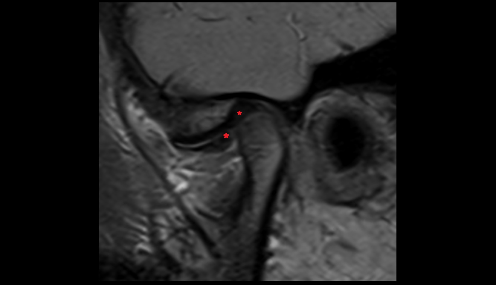 Articular disc of temporomandibular joint