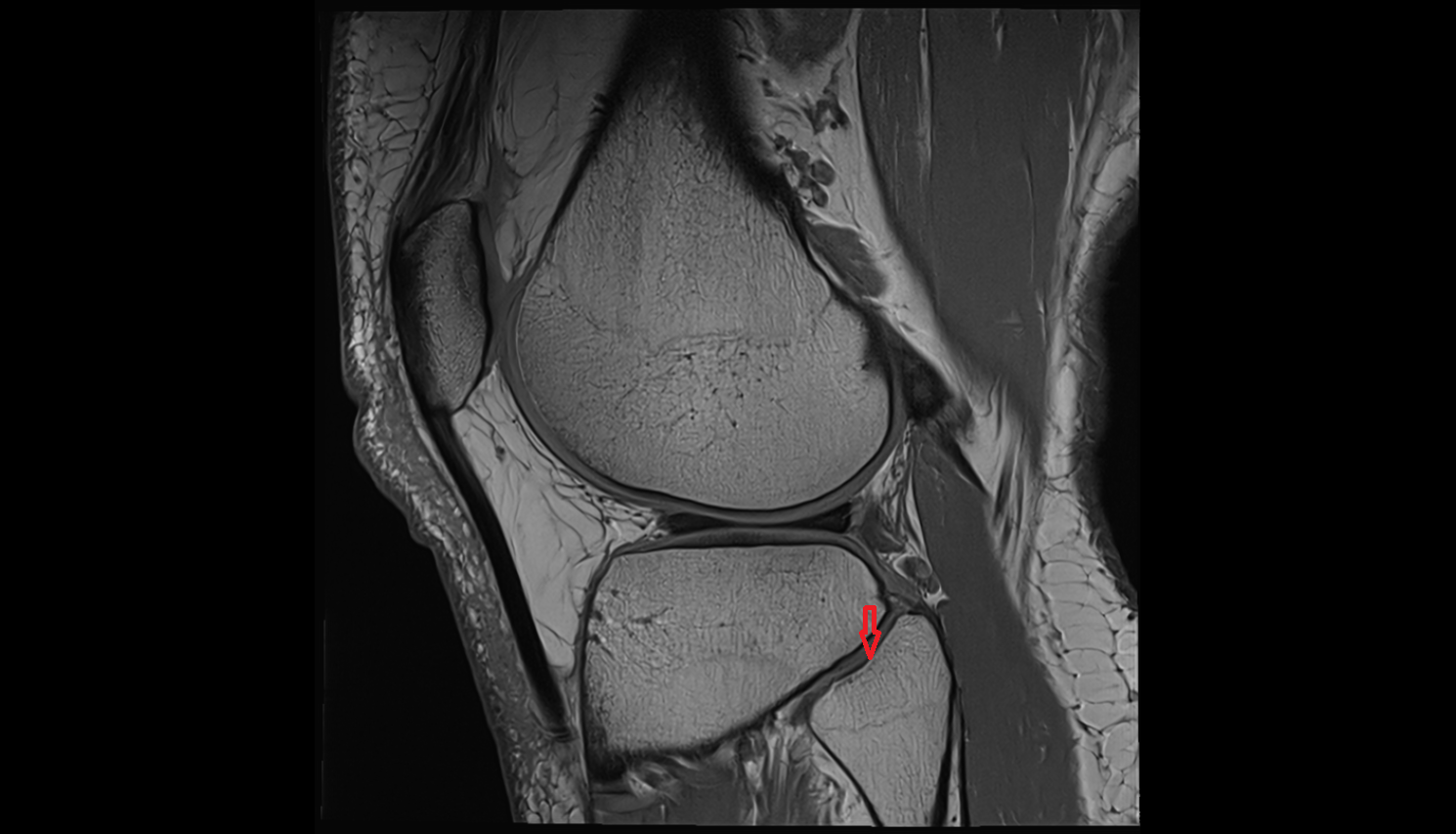 Articular facet of head of fibula  mri  anatomy labelled image-img-00000-00000