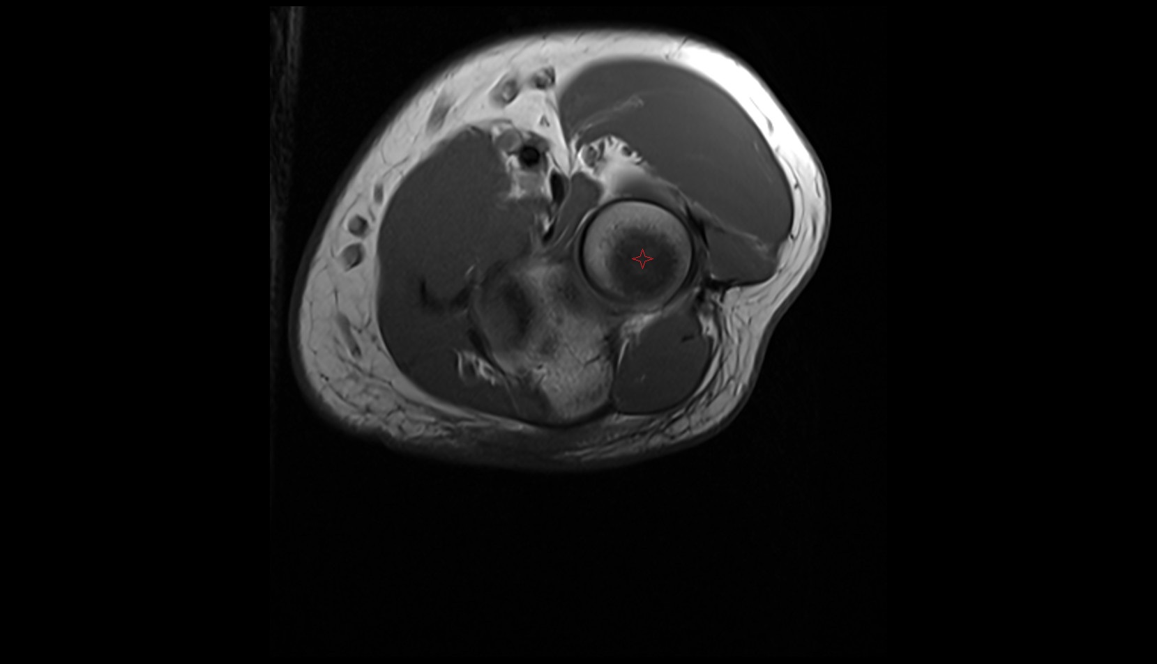 Articular facet of head of radius