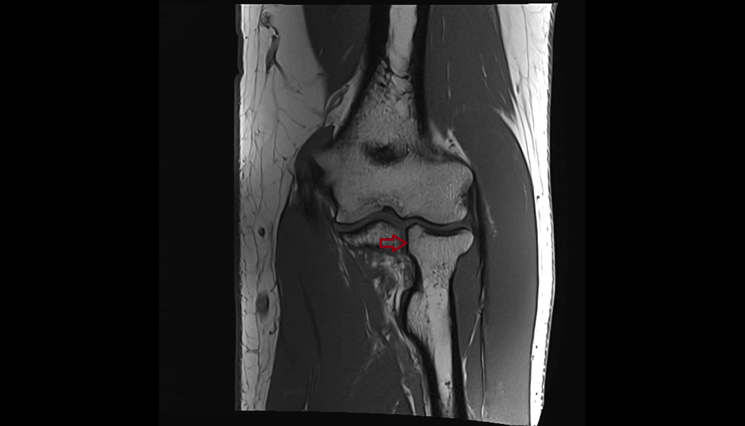 Articular facet of head of radius  x ray  anatomy labelled image-img-00000-00000