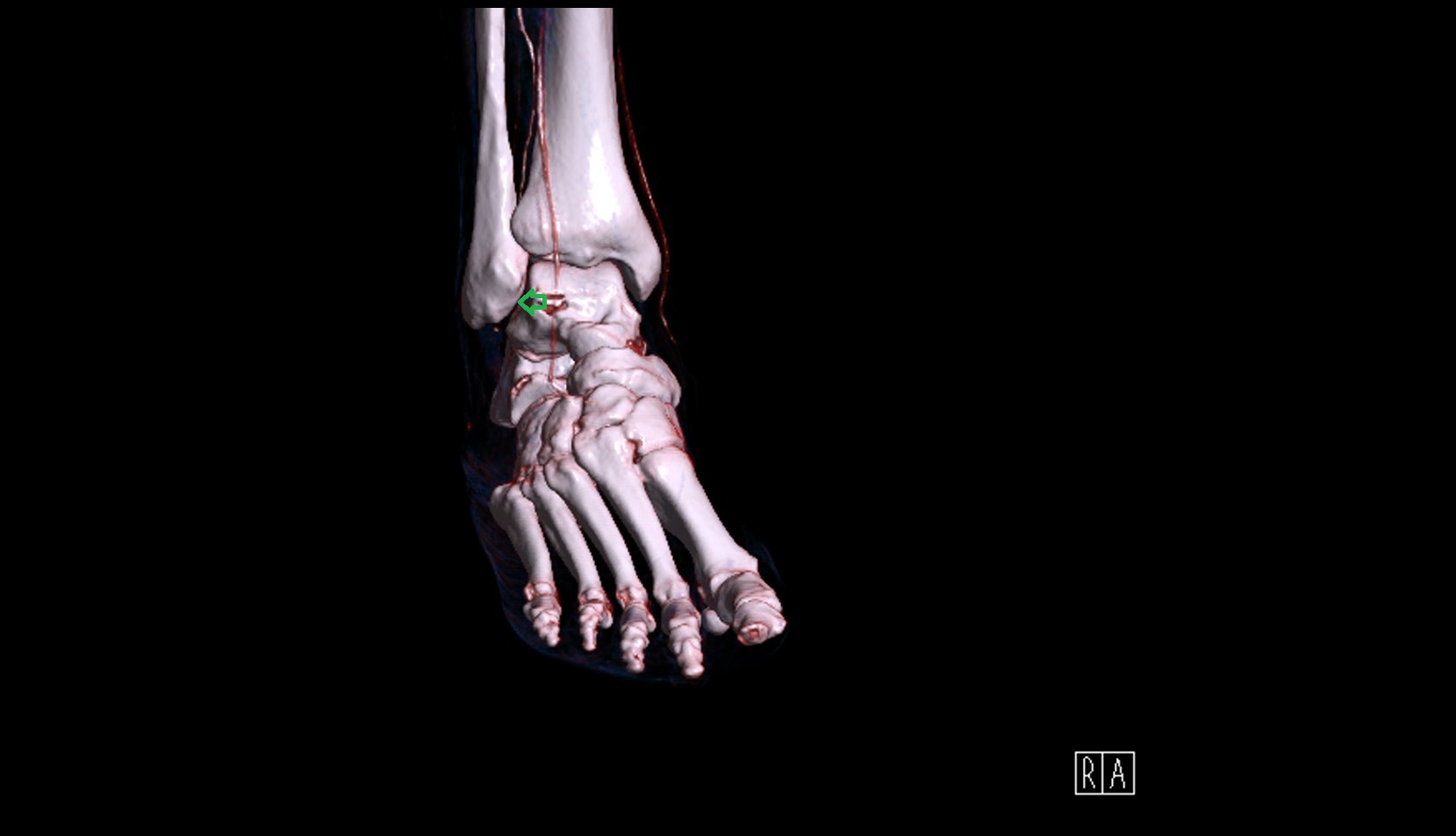 Articular facet of lateral malleolus 3d