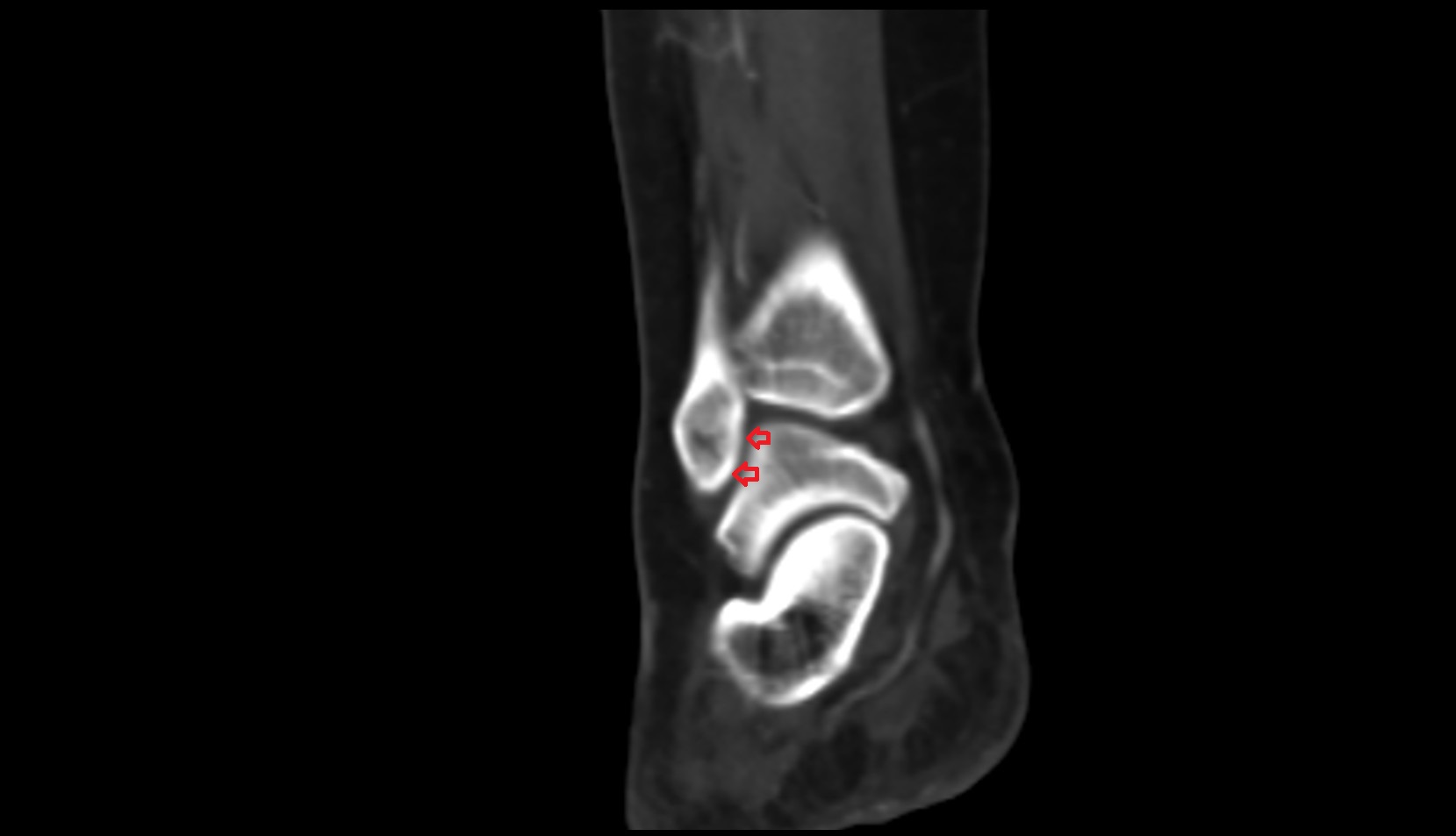 Articular facet of lateral malleolus ct