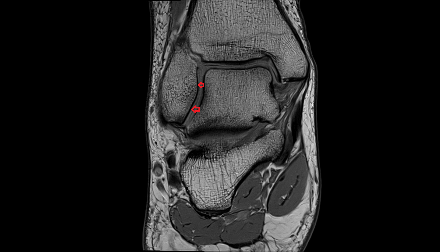 Articular facet of lateral malleolus  mri  anatomy labelled image-img-00000-00000