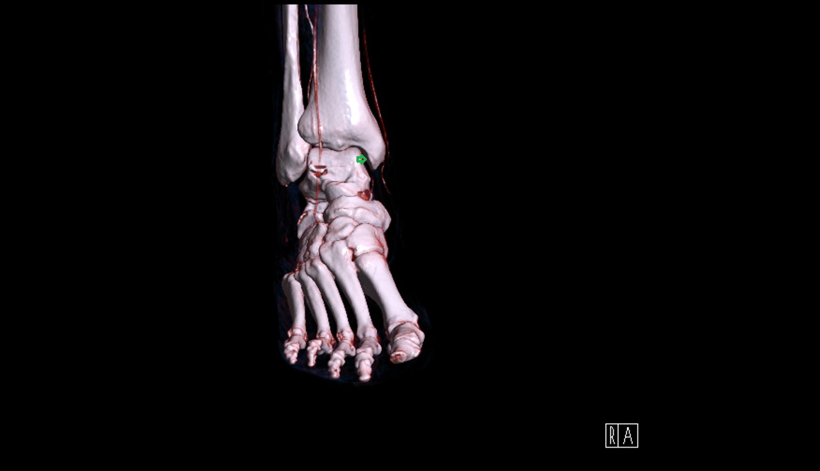 Articular facet of medial malleolus 3d