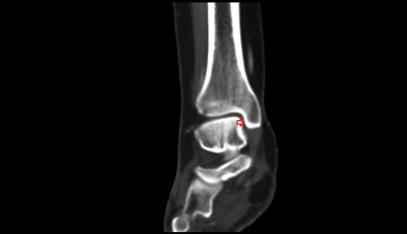 Articular facet of medial malleolus ct