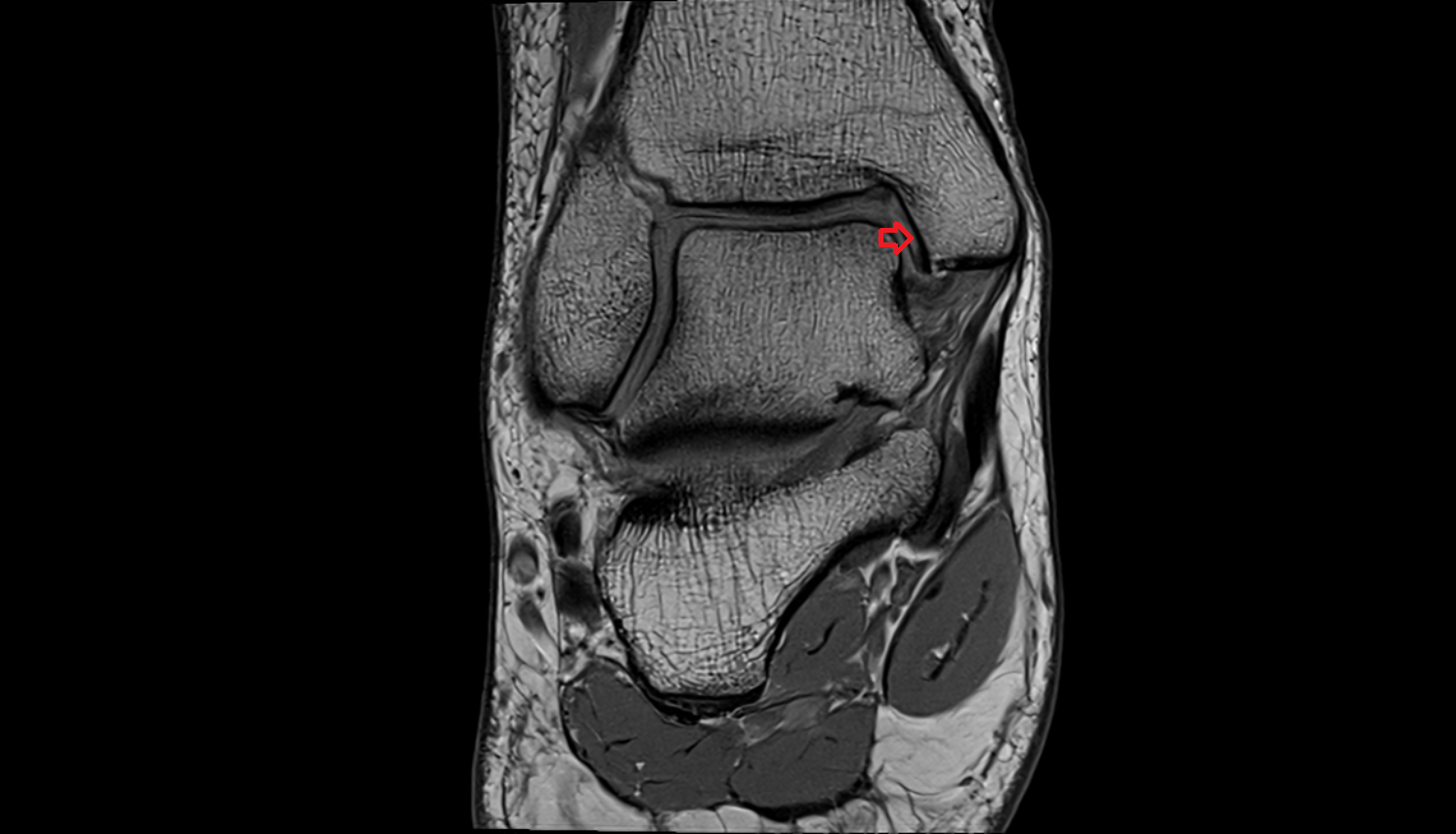 Articular facet of medial malleolus  mri  anatomy labelled image-img-00000-00000