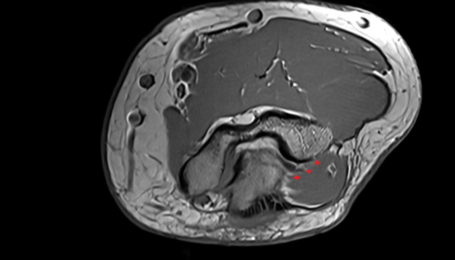 Articularis cubiti muscle  axial cross sectional anatomy 3T MRI AI enhanced radiology image -img-00000-00000