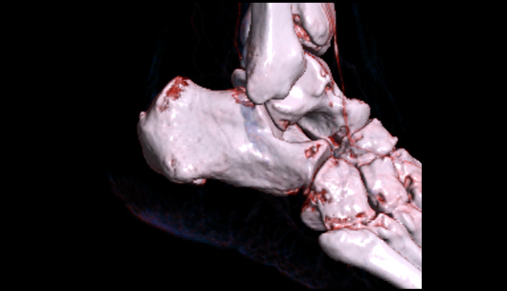 Articular surface for cuboid bone
