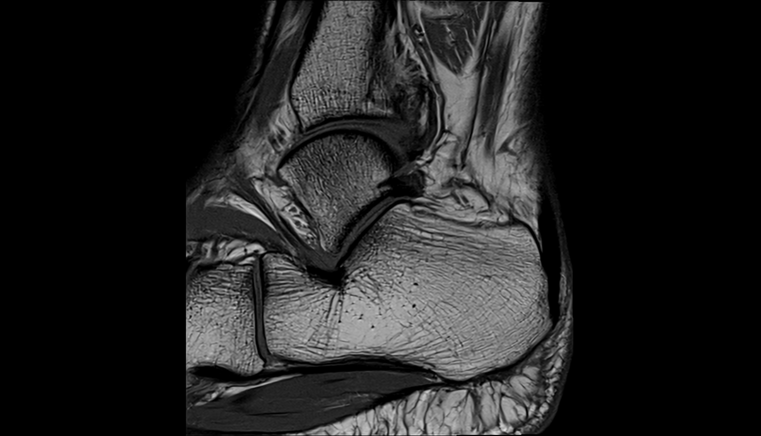 Articular surface for cuboid bone  mri  anatomy labelled image-img-00000-00000