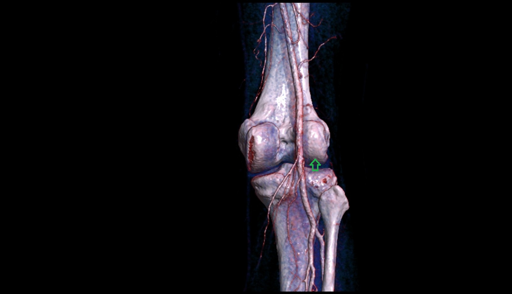 Articular surface of lateral femoral condyle