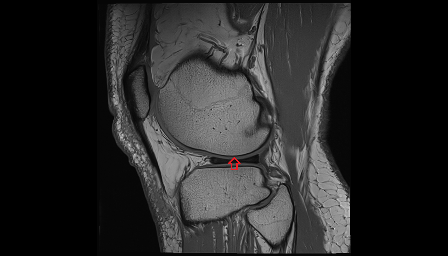Articular surface of lateral femoral condyle mri anatomy labelled image-img-00000-00000