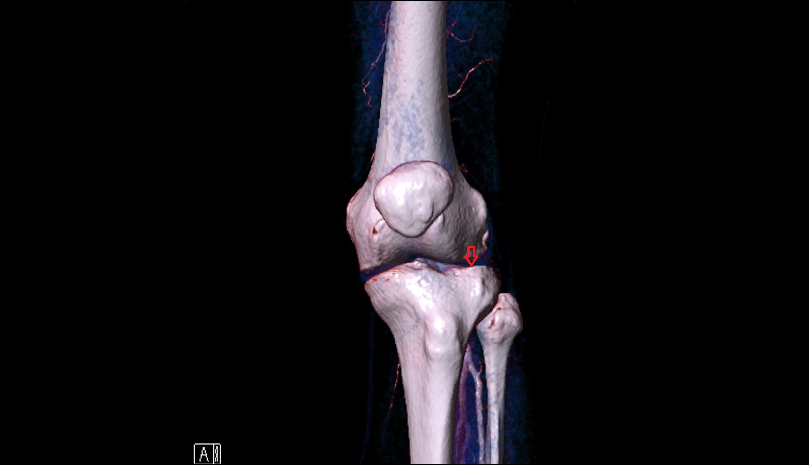 Articular surface of lateral tibial condyle 3d