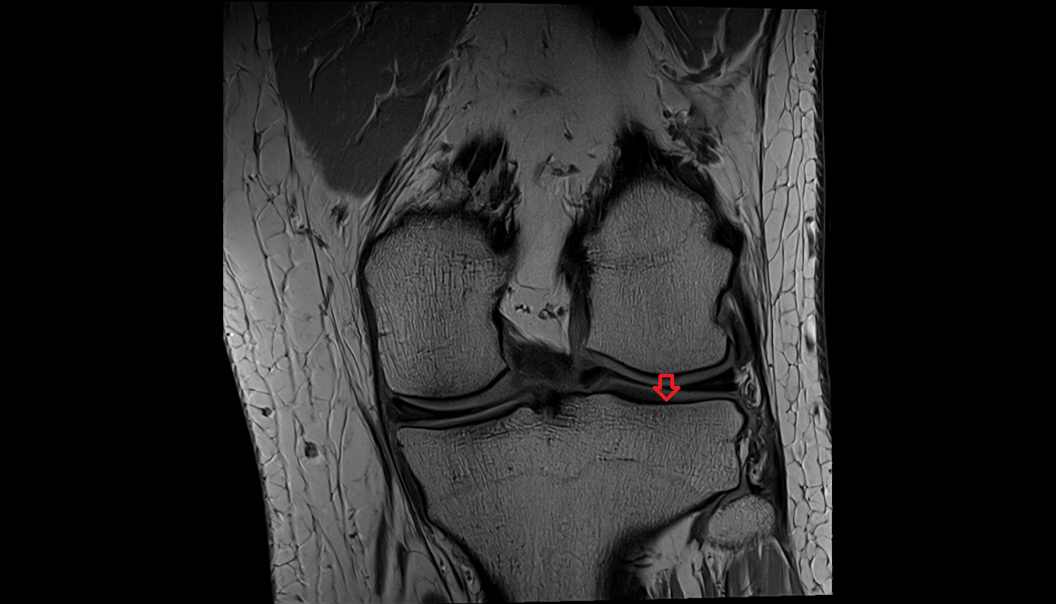 Articular surface of lateral tibial condyle  mri  anatomy labelled image-img-00000-00000