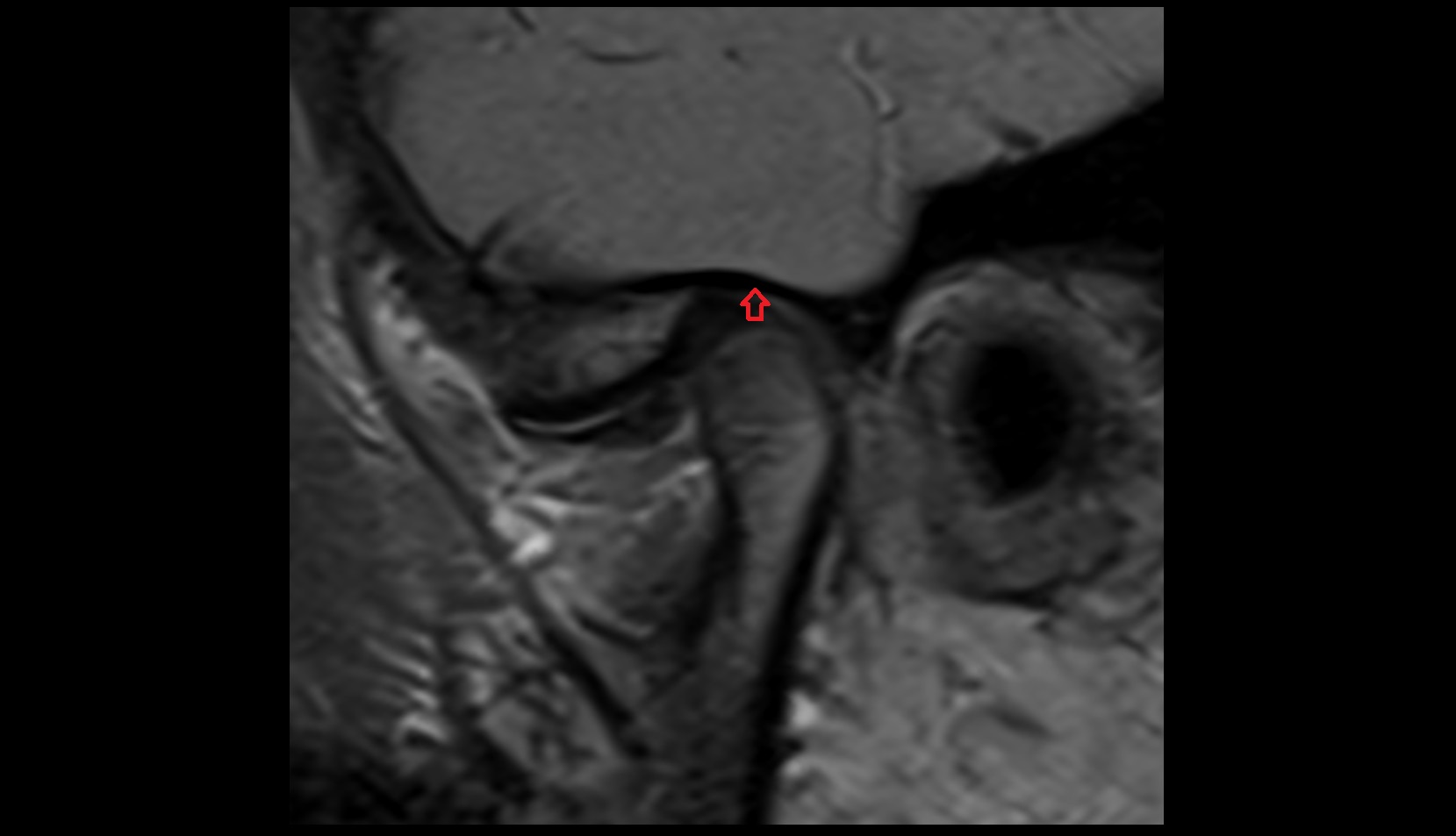 Articular surface of mandibular fossa