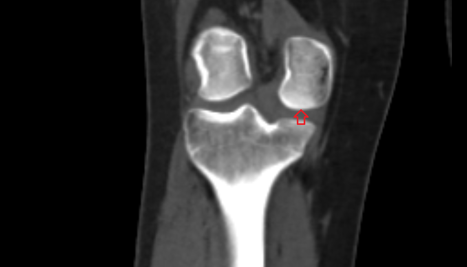 Articular surface of medial femoral condyle ct anatomy labelled image-img-00000-00000