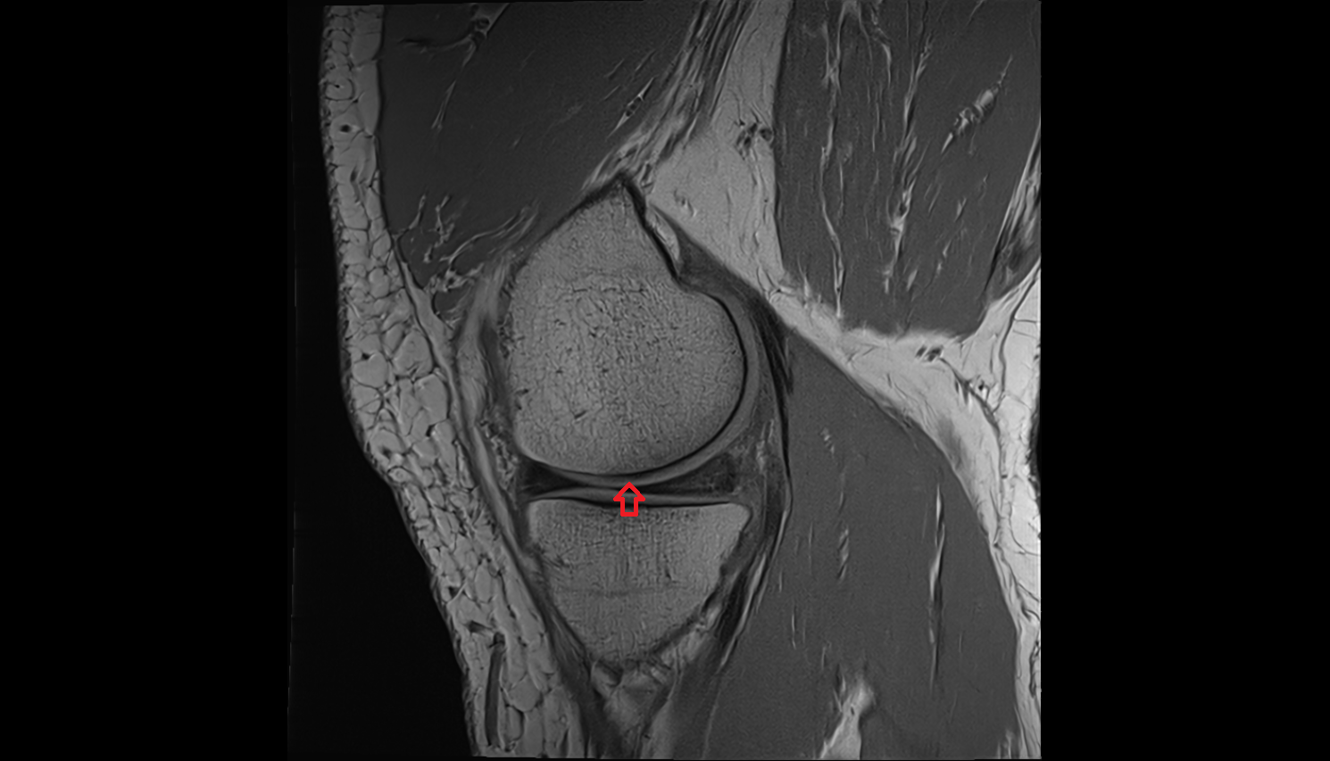 Articular surface of medial femoral condyle ct anatomy labelled image-img-00000-00000_00001