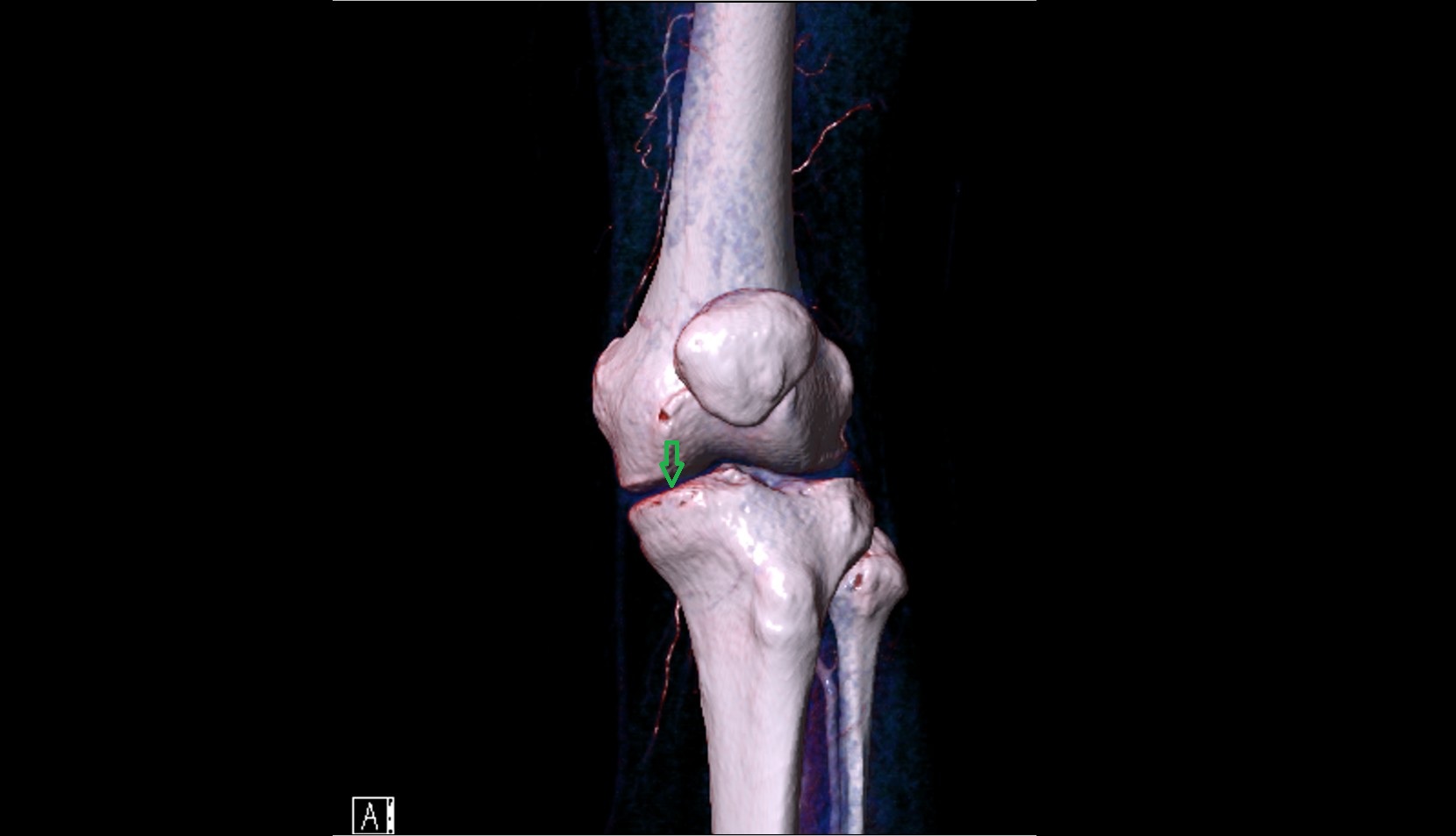 Articular surface of medial tibial condyle 3d