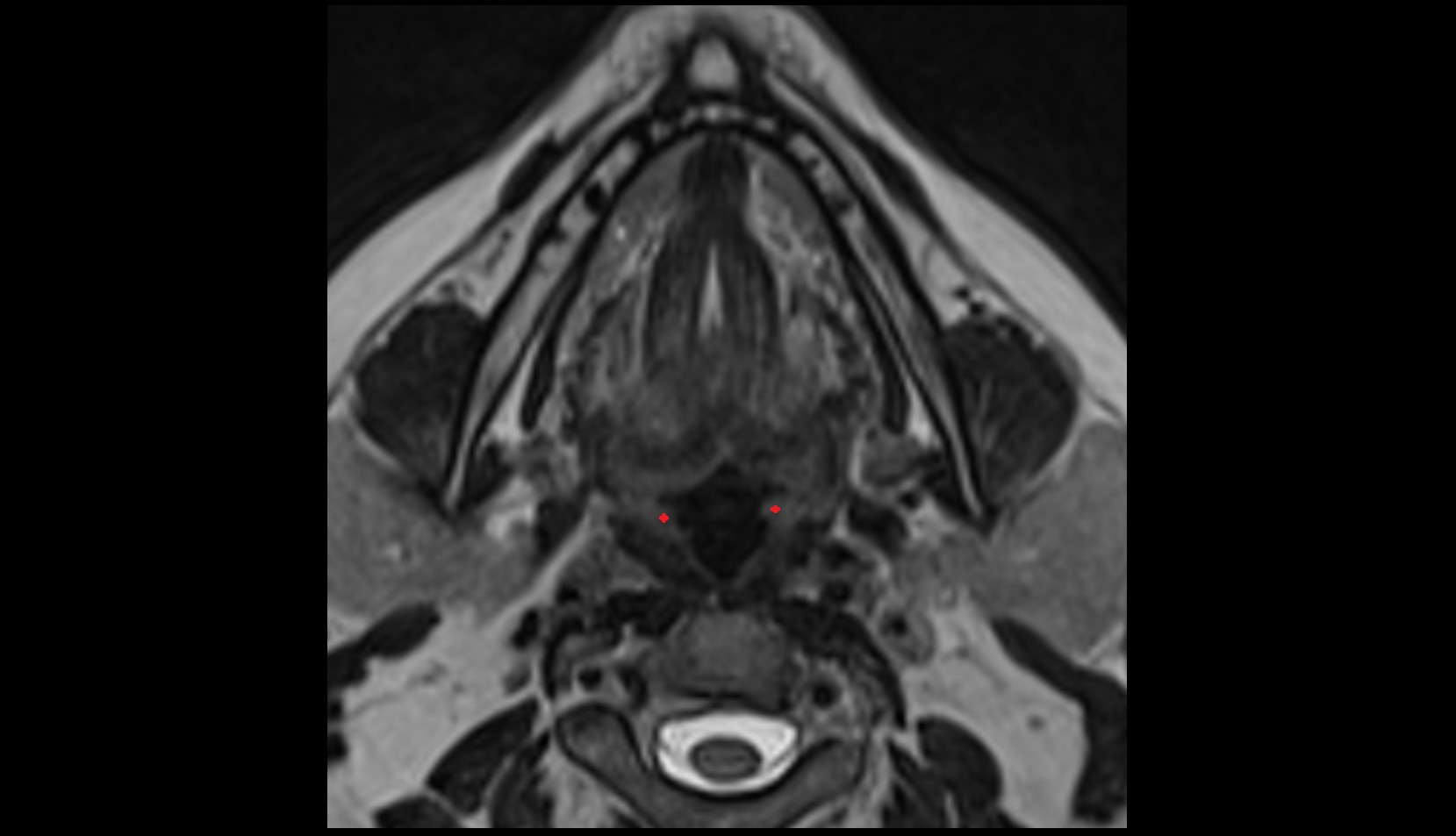 Aryepiglottic fold mri image