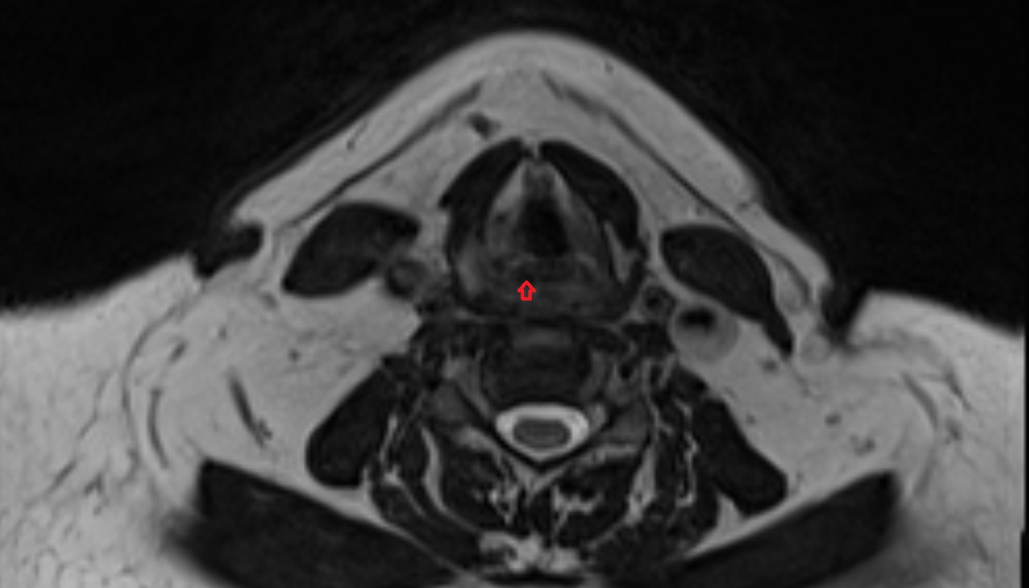 Arytenoid cartilage  mri axial image -img-00000-00000