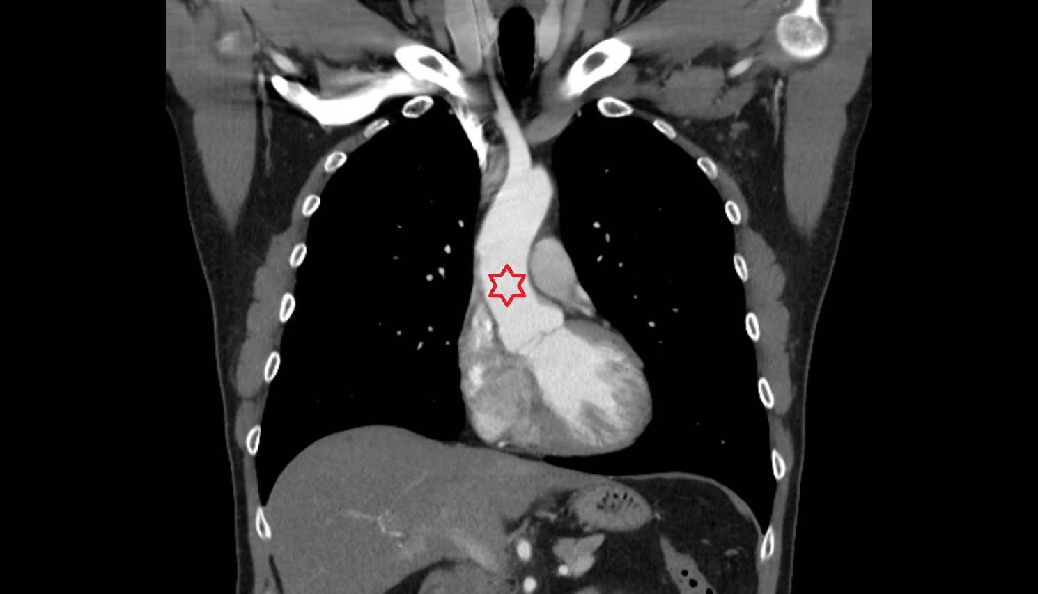 Ascending aorta Anatomy, Location and Imaging Appearance CT anatomy image -img-00000-00000