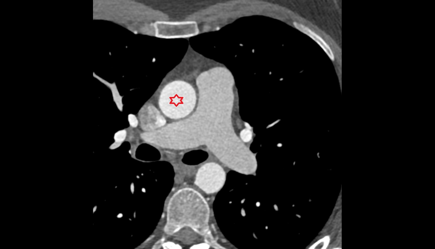 Ascending aorta anatomy CT axial  image -img-00000-00000