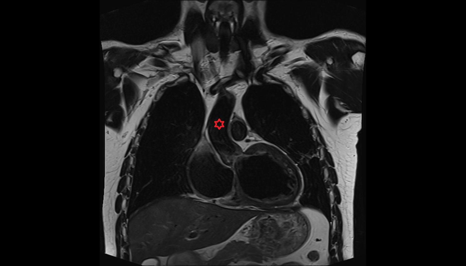 Ascending aorta anatomy  MRI coronal  image -img-00000-00000