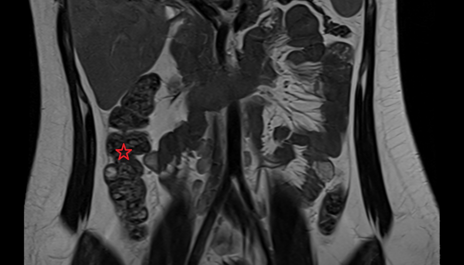Ascending colon  MRI coronal  anatomy  image -img-00000-00000
