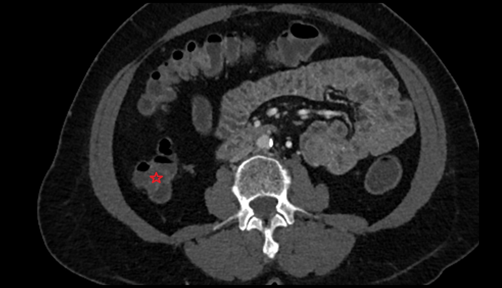 Ascending colon ct axial image
