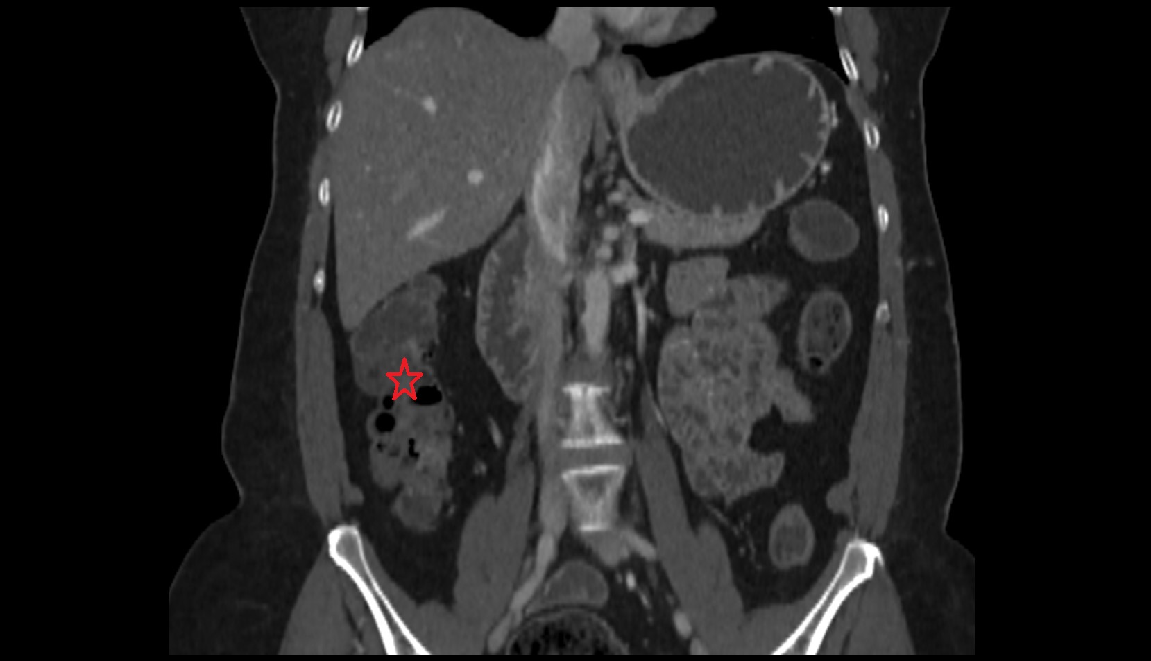 Ascending colon ct coronal image