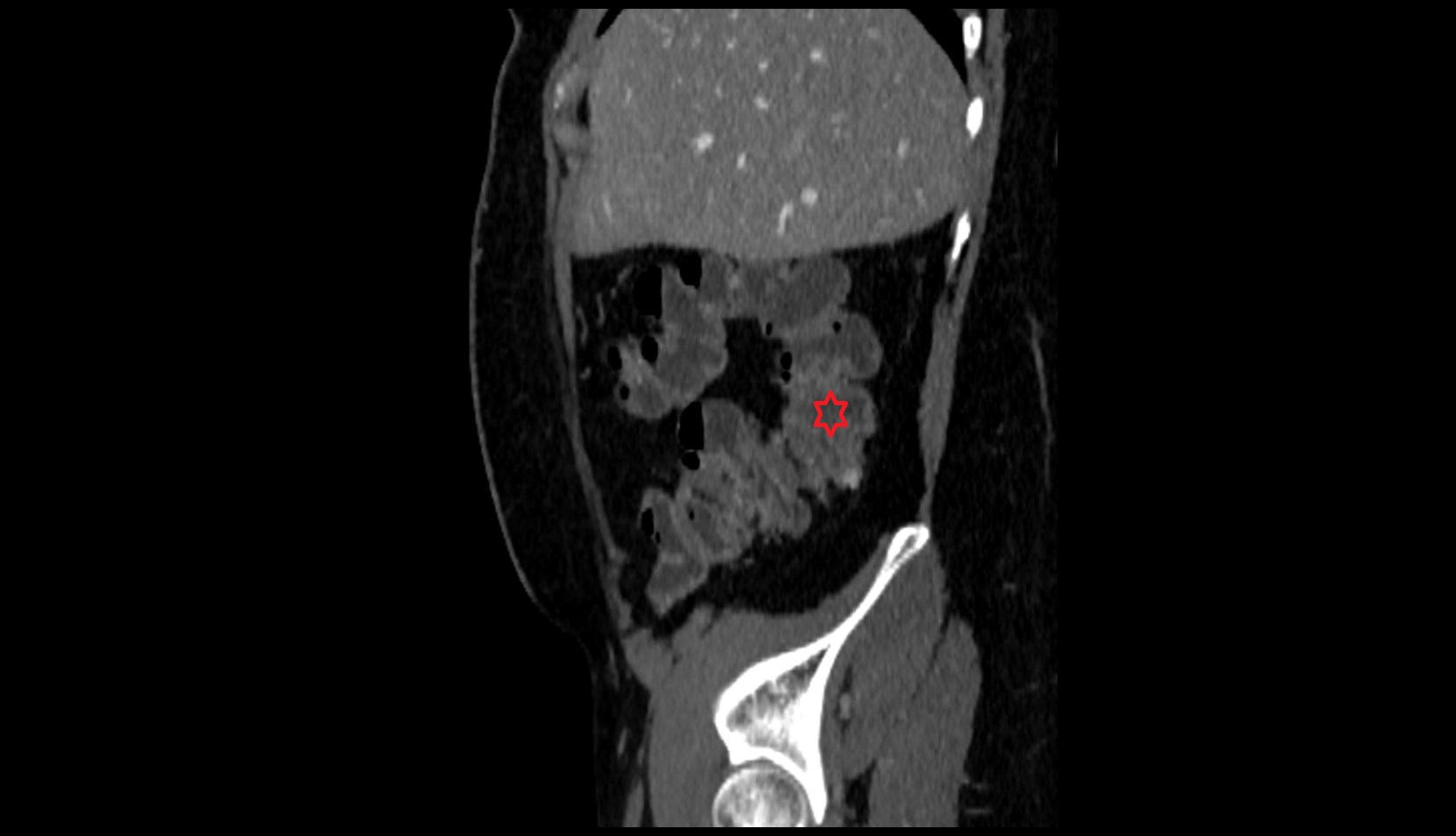 Ascending colon ct sag image
