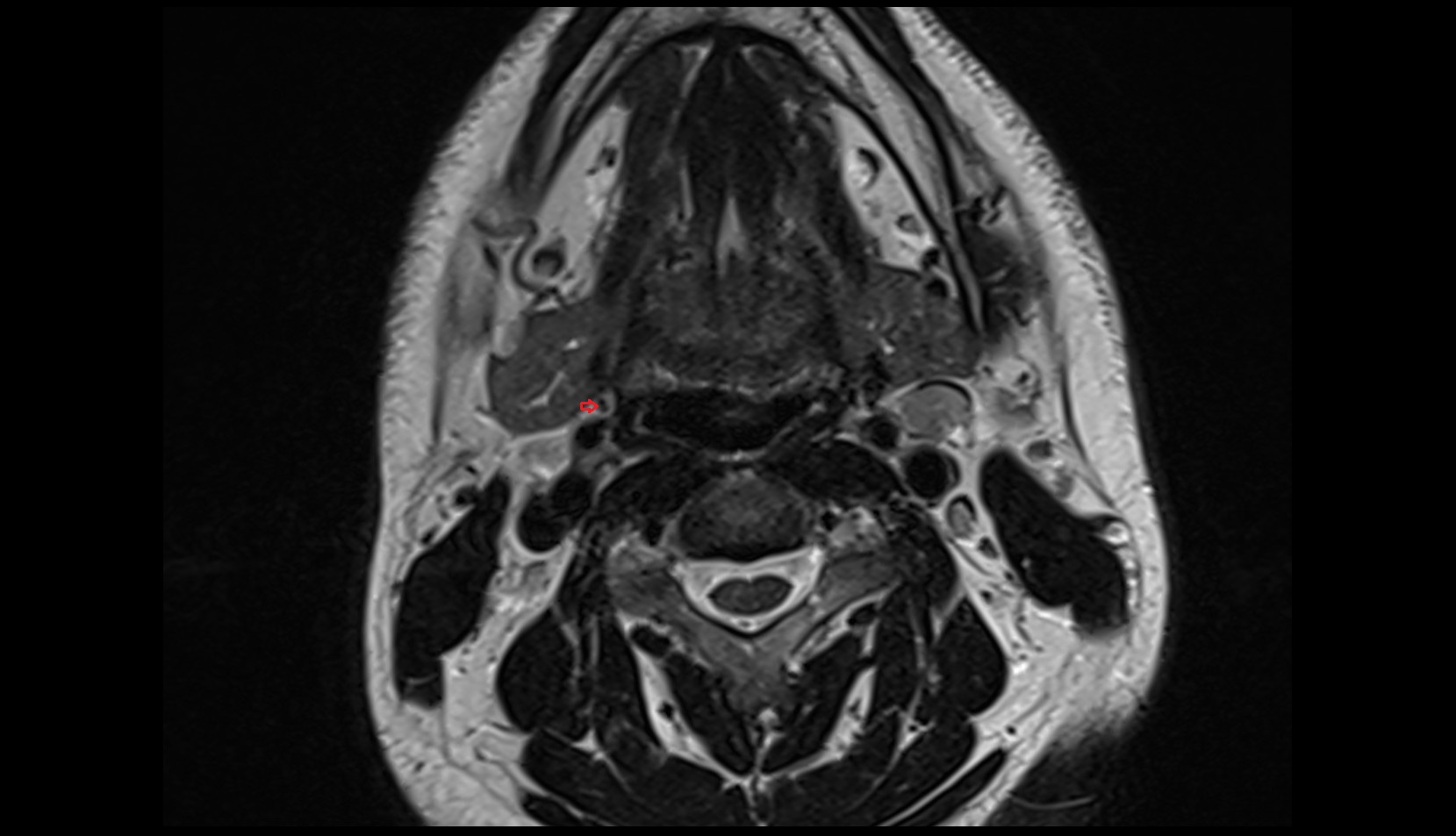 Ascending pharyngeal artery mri axial iamge