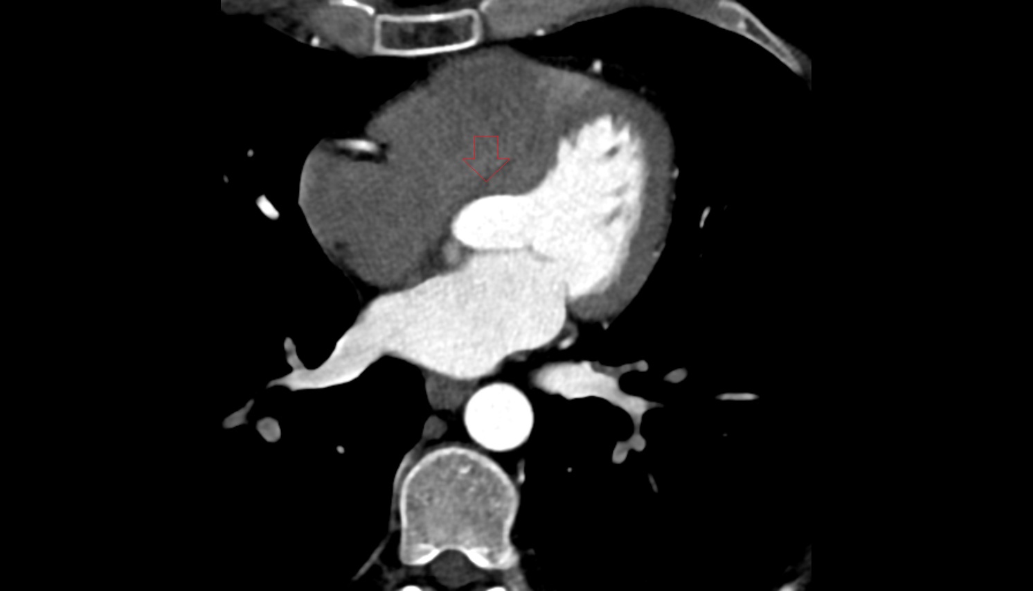 Atrioventricular bundle (bundle of His) anatomy  CT axial   image -img-00000-00000