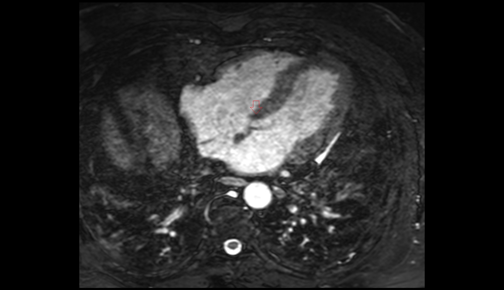 Atrioventricular bundle (bundle of His) mri image